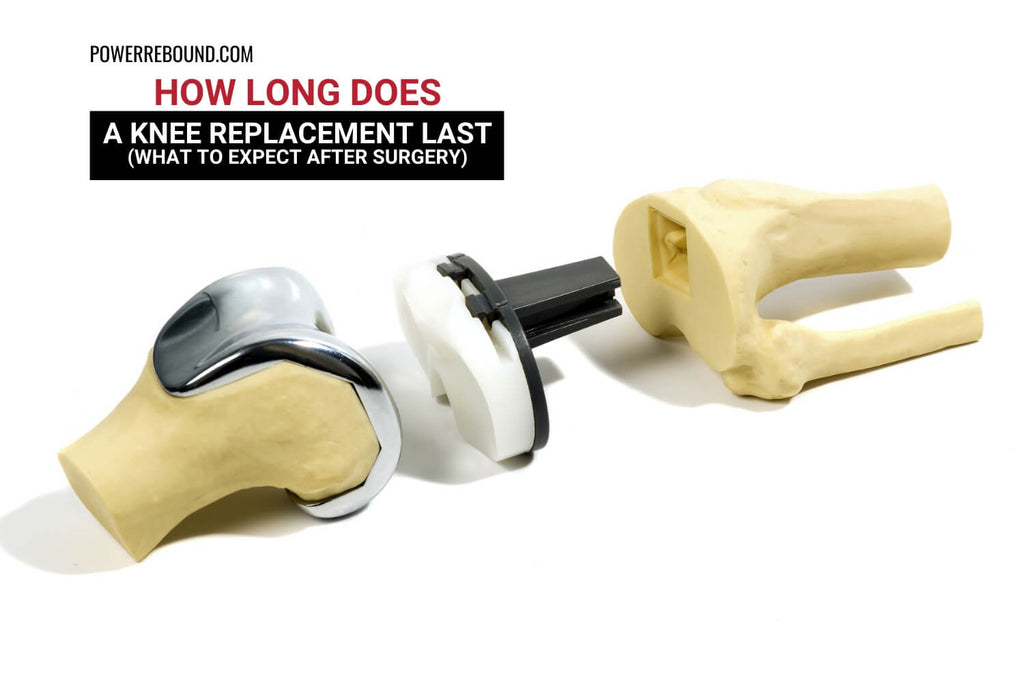 How Long Does a Knee Replacement Last? What to Expect after Surgery