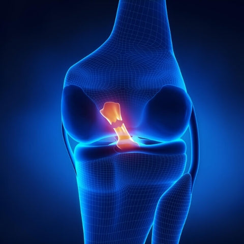 Torn-anterior-cruciate-ligament